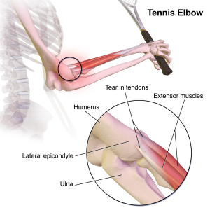tennis elbow terry newmyer